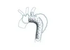 Castor - Branched Aortic Stent-Graft System