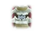 Secure - Model C - Cervical Artificial Disc