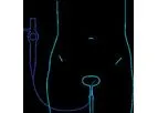Nucleix EpiCheck - Detect Bladder Cancer