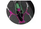 Brainlab - Electromagnetic ENT Navigation