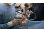 Corneal Transplants