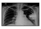 Medicomp TelePatch - Stress-Free Implantable Device Monitoring