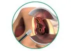 VivAer - Nasal Airway Obstruction Solution