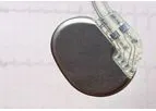 Cardiac Rhythm Management Devices