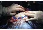 Patient Specific Implant Technology