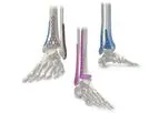 AOS - Fibonacci Lower Extremity Plating System