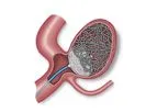 Endura - Embolization Device
