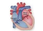 Novostia - Heart Valves
