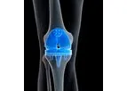 Tecomet - Patellar Components