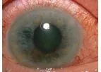 InMed - Model INM-088 - Topical Eye Drop for the Treatment of Glaucoma