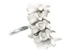 Atlas - Model HiJAK AC - Cervical Spine Spacer System