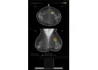 Lunit - Version INSIGHT MMG - Mammography AI Solutions