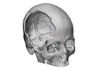 Matrix - Customized Implants