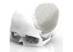 Renishaw - Craniomaxillofacial Implants and Software