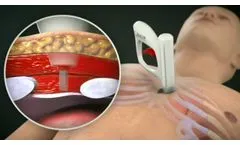 AtaCor Medical - MedTech Innovator Best Competition - Video