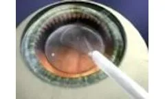 Meet the Visian ICL - Video