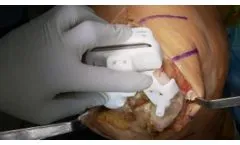 iTotal Identity Live Surgery With Rob Tait, MD and William Kurtz, MD. - Video