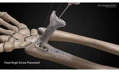 Osteomed ExtremiLOCK Wrist video