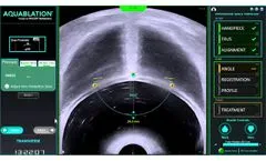 AquaBeam Robotic System - Personalized Treatment Planning, Transverse View 2019 - Video