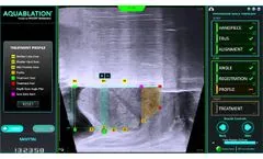 AquaBeam Robotic System - Personalized Treatment Planning, Sagittal - Video