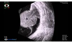B-Scan Tumor with Vasculature - Video