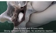 Bionacre a MBP Natural Biomaterial for Vertebroplasty - Video