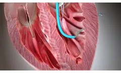 Helix Transendocardial Delivery System - Video