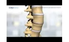 DiscGenics` IDCT Cell Therapy for DDD - Video