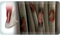 Learn About RCT-01 Chronic Achilles Tendinosis Treatment - Video