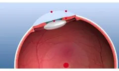 SCHWIND Amaris 500E with 5D Eyetracking - Audio Version - Video