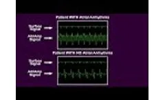 AtriAmp Atrial Electrogram on Bedside Monitor (Atrial Arrhythmia and Sinus Rhythm) - Video
