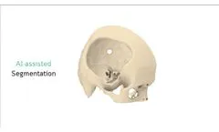 How do surgeon work with Meticuly - Video
