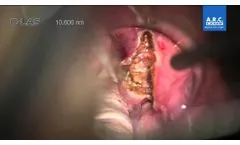 ENT CO2 Superglottis Carcinoma Hornung 2015 - Video