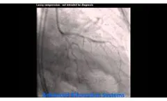 Pre LCx OM1 - Advanced Bifurcation Systems - Video