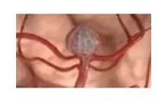 Neqstent Coil Assisted Flow Diverter - Video