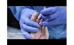 OSSIOfiber Hammertoe Fixation System Surgical Technique with Mark Prissel, DPM - Video