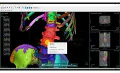OOOPDS - Surgical Planning for a Spinal Puncture (Vertebroplasty) - Video