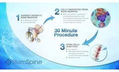 StemSpine Procedure for Degenerative Disk Disease and Chronic Lower Back Pain - Video