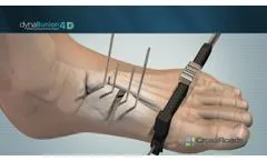 DynaBunion 4D Minimal-Incision Lapidus System - Featuring Gen 2 Instruments - Video