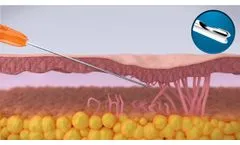 GTI Cannula Animation - How the GTI Cannula Works - Video