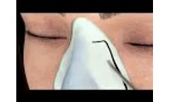 Septo-Rhinoplasty 3D Protocol - Piezotome M+ - Video