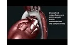 Ascyrus Medical Dissection Stent - Video
