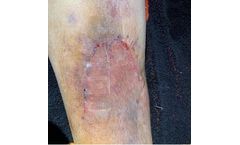 Surgical Skin Closure for General Healthcare