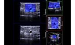 Ultrasound System for Breast Cancer Patients