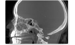 SeeFactor CT3 for Consider Ear, Nose & Throat (ENT)