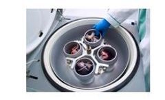 Acute Kidney Injury (AKI) Device for Reduction of Galectin-3 Levels