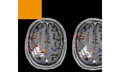 NBS - Navigated Brain Stimulation System for Radiotherapy