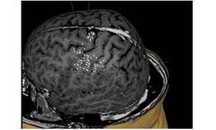 NBS - Navigated Brain Stimulation System for Brain Surgery