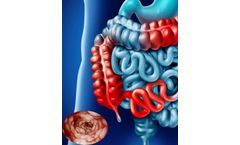 Peri-anal Fistula