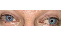 Artificialiris Medical Device for Patient